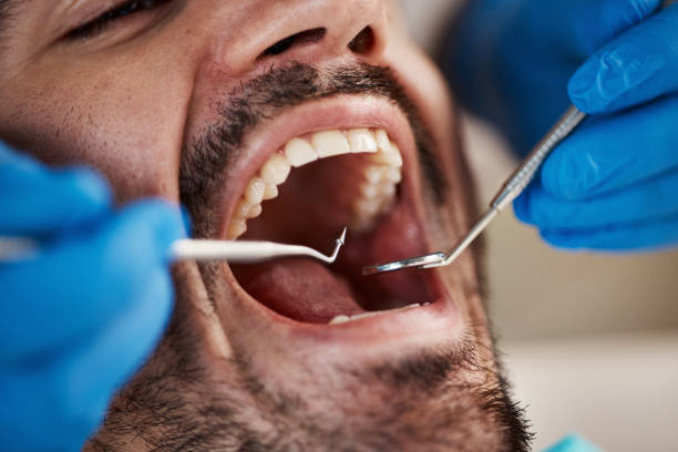 Best Chipped Tooth Repair Near Me  in Homestead Meadows South, TX